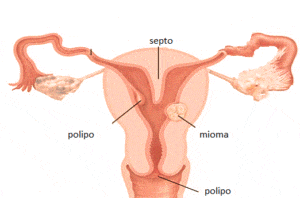 Histeroscopia para tratar la infertilidad