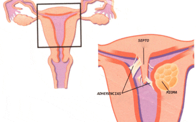 Histeroscopia para tratar la esterilidad