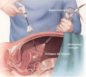 laparoscopia ginecológica