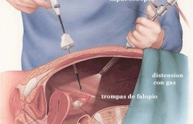 La laparoscopia como técnica para tratar la esterilidad