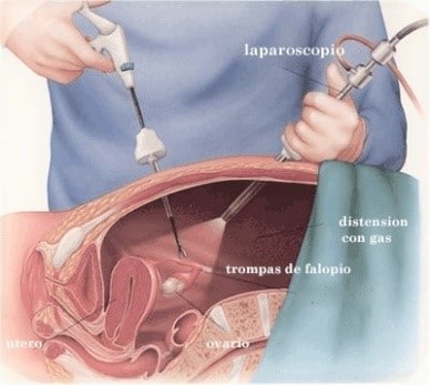 La laparoscopia como técnica para tratar la esterilidad